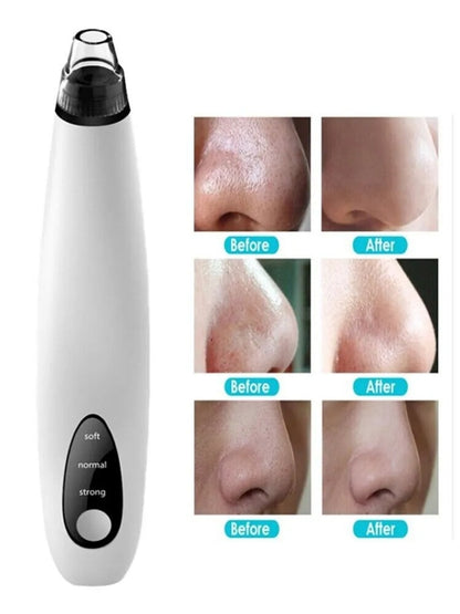 Electric Blackhead Remover Vacuum – Deep Pore Cleaner for Whiteheads & Acne Removal