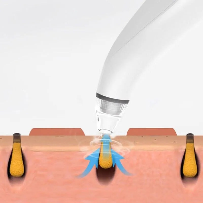 Electric Blackhead Remover Vacuum – Deep Pore Cleaner for Whiteheads & Acne Removal